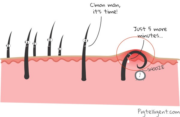 Viêm nhiễm lông nách