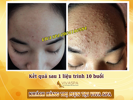 Kết quả sau khi kết thúc liệu trình chị mụn của chị Dương tại Viva Spa