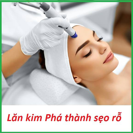 Lăn kim trị sẹo rỗ hiệu quả bất ngờ